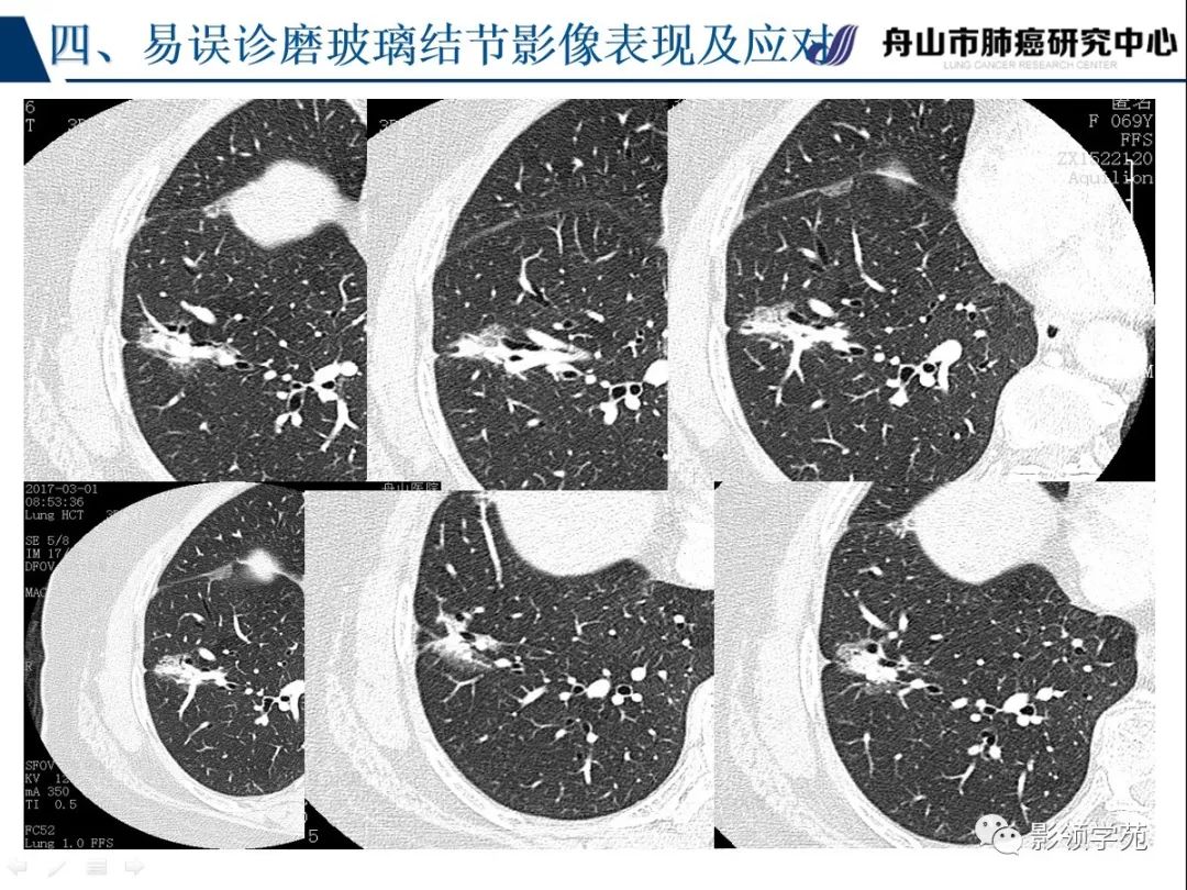 影像PPT - 【PPT】肺良恶性结节CT征象及鉴别诊断-85