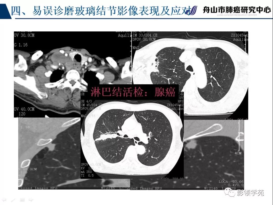 影像PPT - 【PPT】肺良恶性结节CT征象及鉴别诊断-87