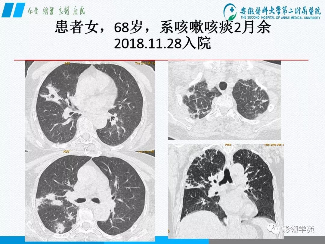 影像PPT - 【PPT】间质性肺炎病理及影像认识-2 影像PPT - 【PPT】间质性肺炎病理及影像认识-2