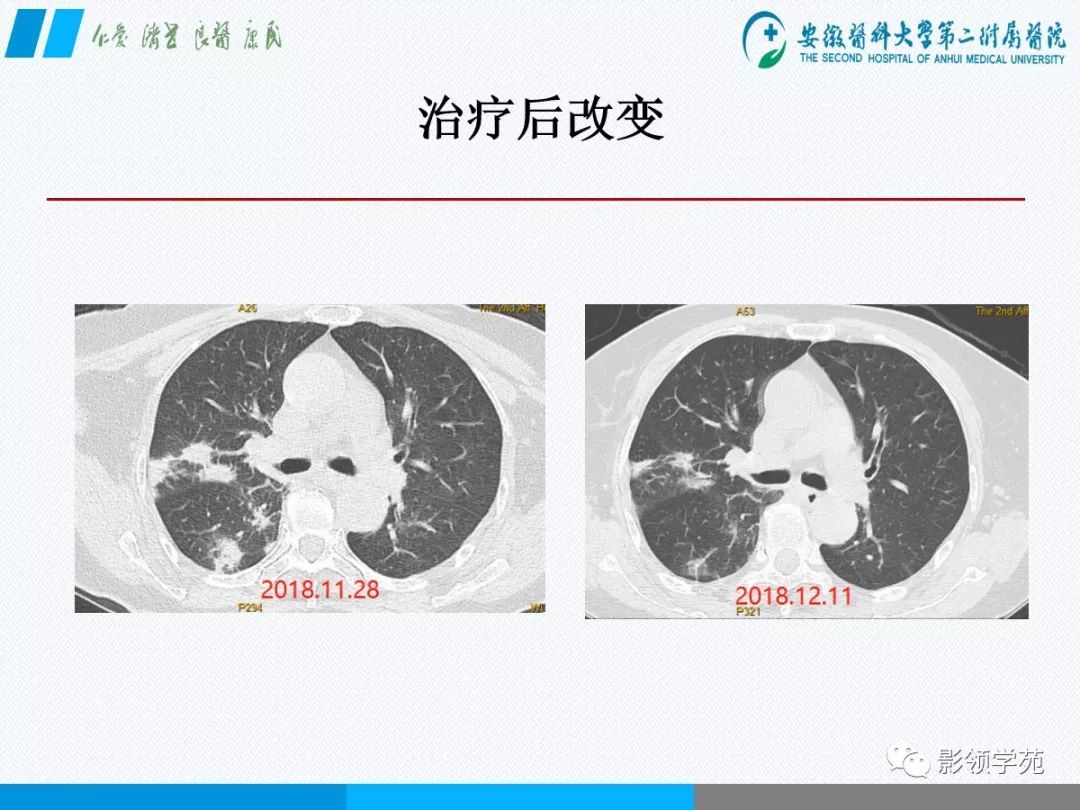 影像PPT - 【PPT】间质性肺炎病理及影像认识-3 影像PPT - 【PPT】间质性肺炎病理及影像认识-3