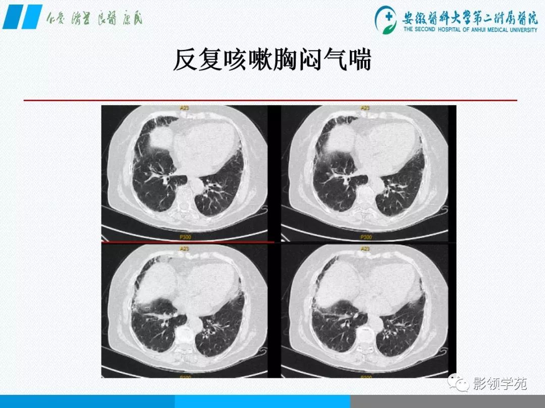 影像PPT - 【PPT】间质性肺炎病理及影像认识-6 影像PPT - 【PPT】间质性肺炎病理及影像认识-6