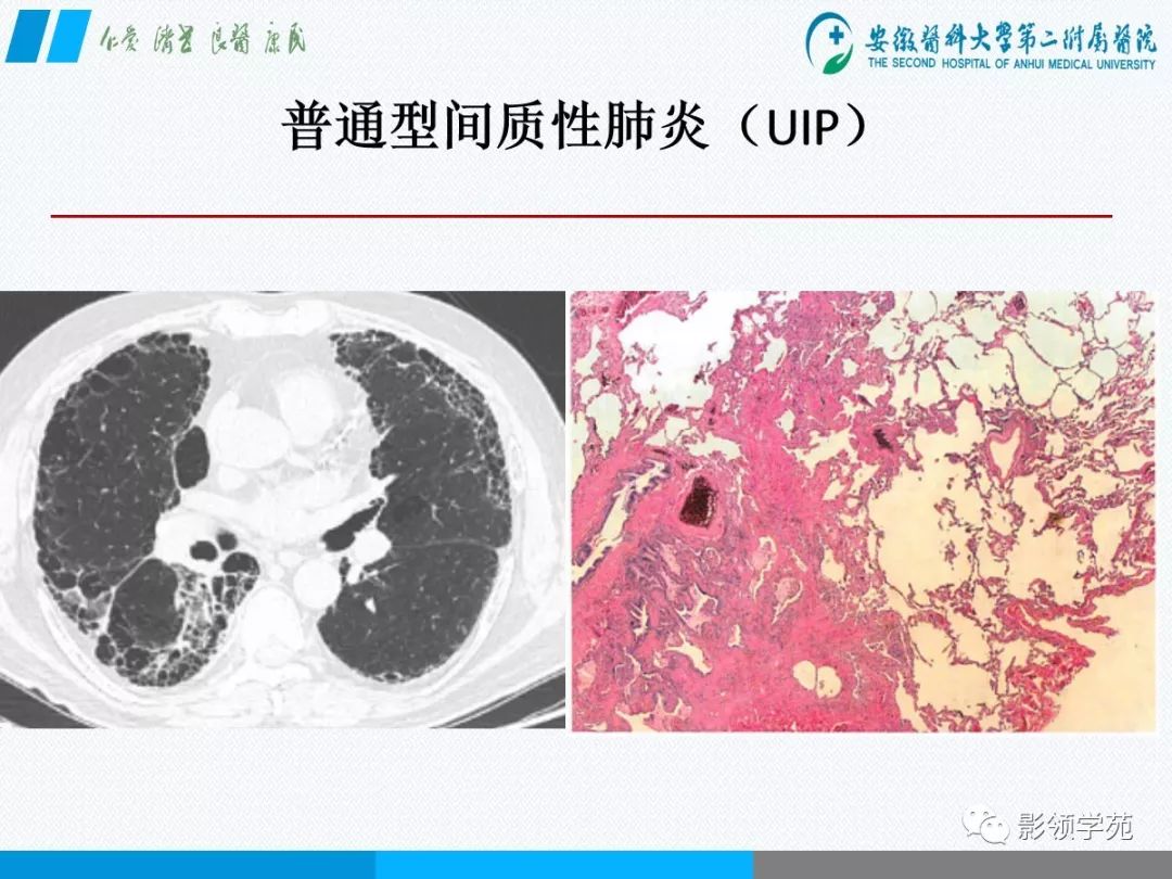 影像PPT - 【PPT】间质性肺炎病理及影像认识-8 影像PPT - 【PPT】间质性肺炎病理及影像认识-8