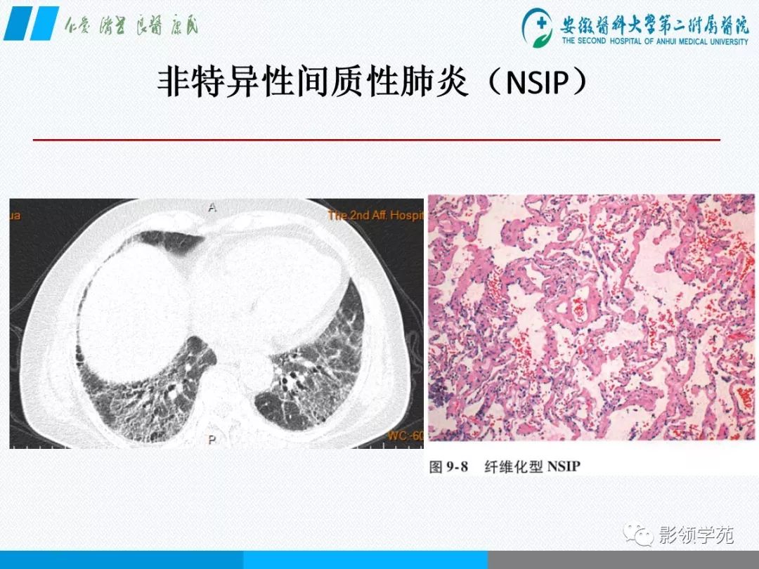 影像PPT - 【PPT】间质性肺炎病理及影像认识-11 影像PPT - 【PPT】间质性肺炎病理及影像认识-11