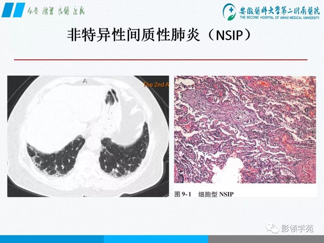 影像PPT - 【PPT】间质性肺炎病理及影像认识-10 影像PPT - 【PPT】间质性肺炎病理及影像认识-10