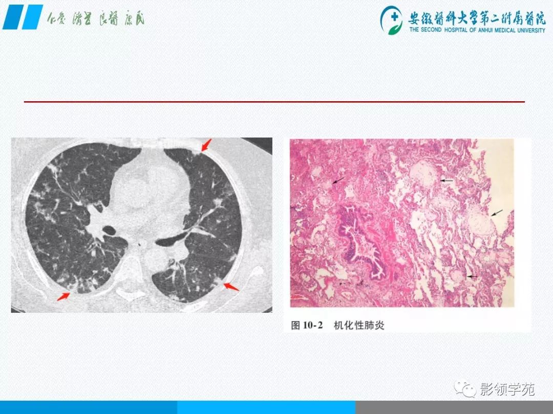 影像PPT - 【PPT】间质性肺炎病理及影像认识-13 影像PPT - 【PPT】间质性肺炎病理及影像认识-13