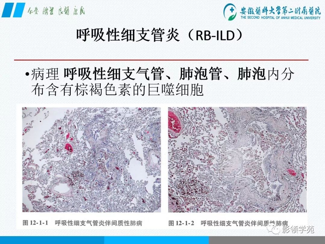 影像PPT - 【PPT】间质性肺炎病理及影像认识-14 影像PPT - 【PPT】间质性肺炎病理及影像认识-14