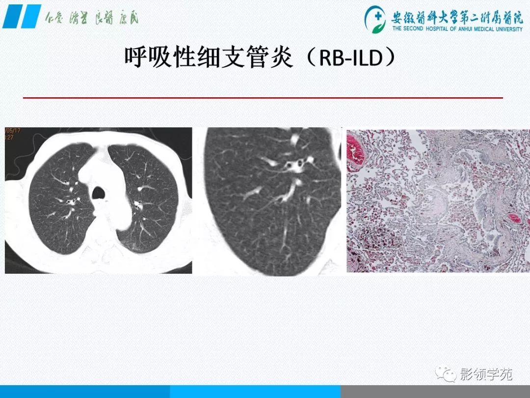 影像PPT - 【PPT】间质性肺炎病理及影像认识-15 影像PPT - 【PPT】间质性肺炎病理及影像认识-15