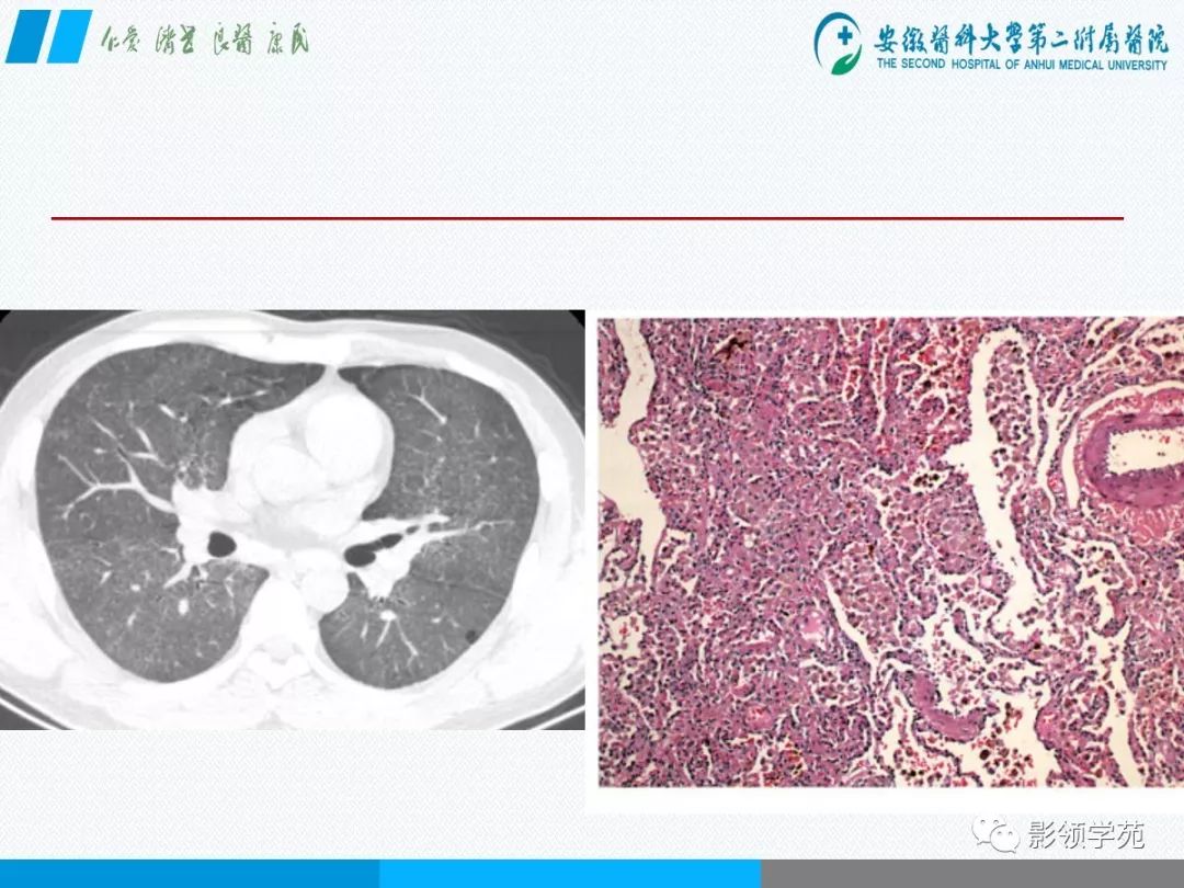 影像PPT - 【PPT】间质性肺炎病理及影像认识-17 影像PPT - 【PPT】间质性肺炎病理及影像认识-17