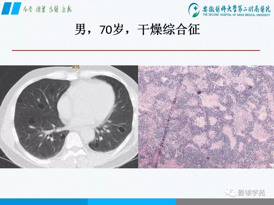 影像PPT - 【PPT】间质性肺炎病理及影像认识-19 影像PPT - 【PPT】间质性肺炎病理及影像认识-19
