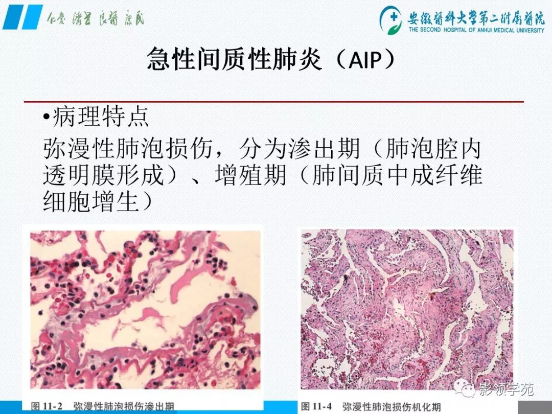 影像PPT - 【PPT】间质性肺炎病理及影像认识-20 影像PPT - 【PPT】间质性肺炎病理及影像认识-20