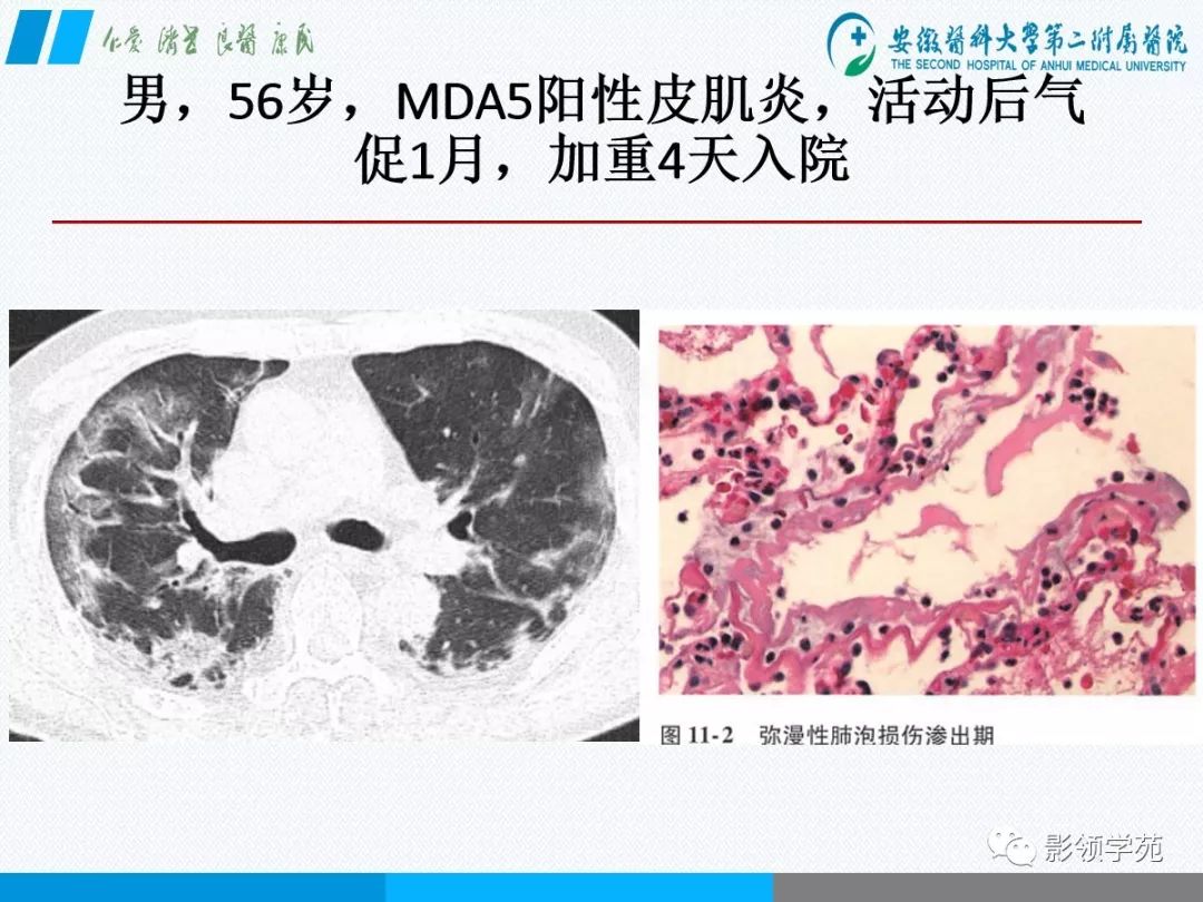 影像PPT - 【PPT】间质性肺炎病理及影像认识-21 影像PPT - 【PPT】间质性肺炎病理及影像认识-21