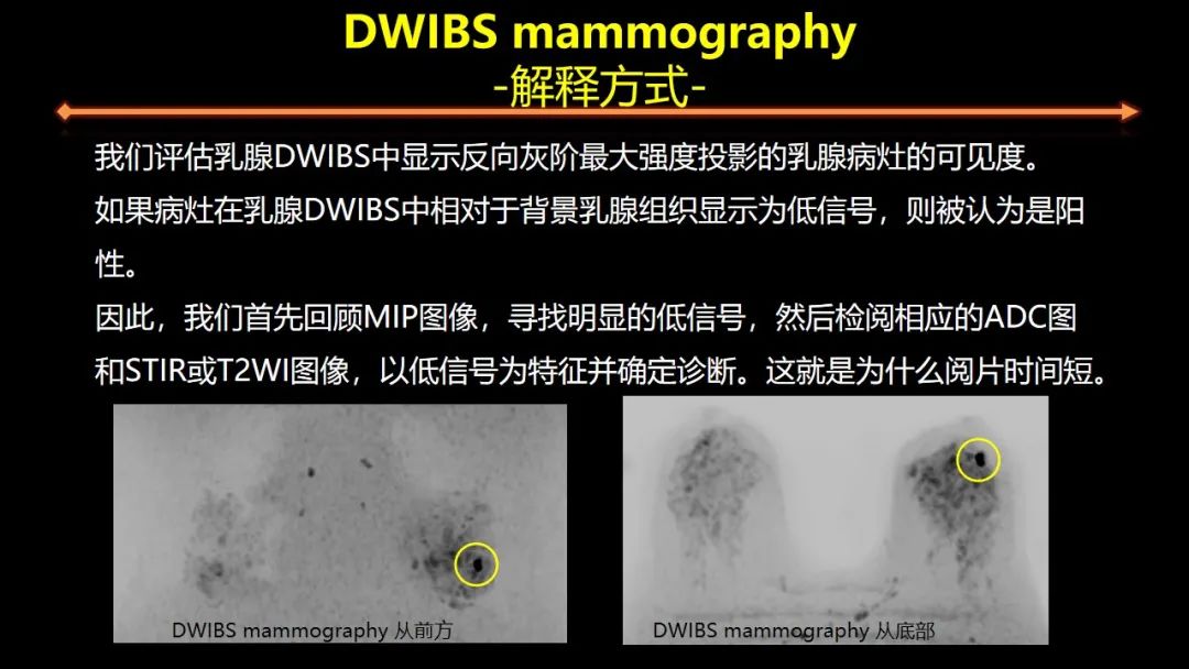 影像PPT - 【PPT】女性致密型乳腺的MR平扫筛查-36
