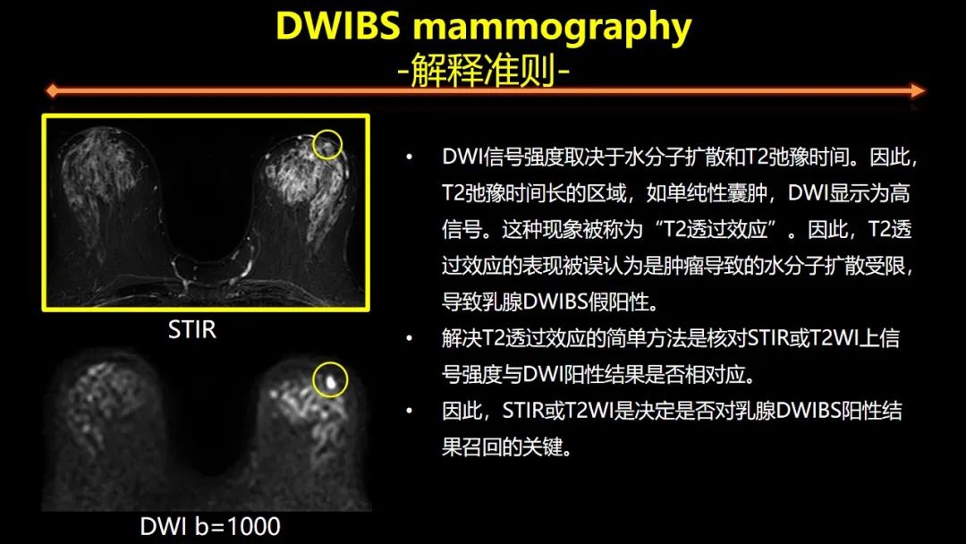 影像PPT - 【PPT】女性致密型乳腺的MR平扫筛查-40