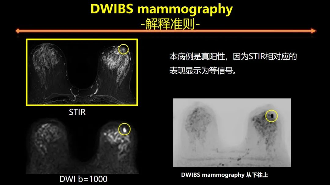 影像PPT - 【PPT】女性致密型乳腺的MR平扫筛查-42