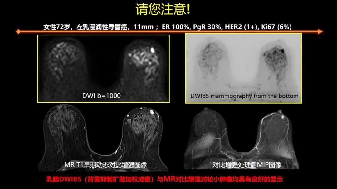 影像PPT - 【PPT】女性致密型乳腺的MR平扫筛查-46
