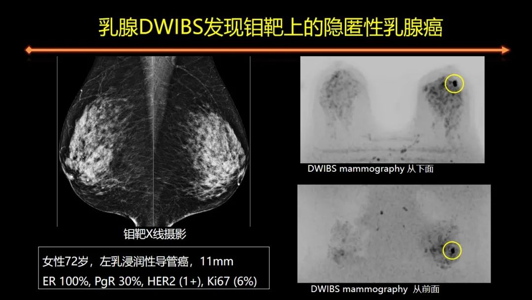 影像PPT - 【PPT】女性致密型乳腺的MR平扫筛查-44