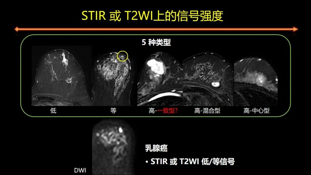 影像PPT - 【PPT】女性致密型乳腺的MR平扫筛查-52