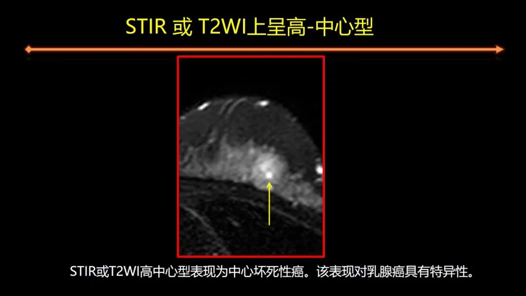 影像PPT - 【PPT】女性致密型乳腺的MR平扫筛查-54