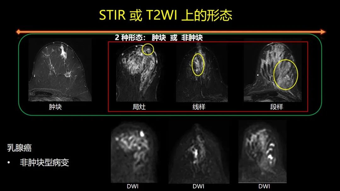 影像PPT - 【PPT】女性致密型乳腺的MR平扫筛查-56