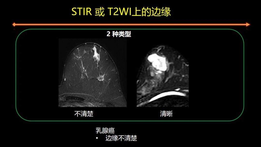 影像PPT - 【PPT】女性致密型乳腺的MR平扫筛查-58