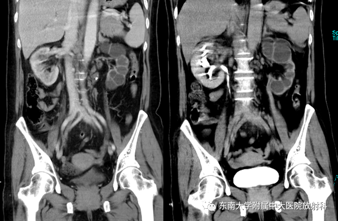 影像PPT - 【PPT】肾结核的影像诊断-3