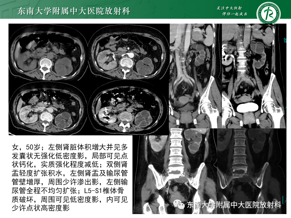 影像PPT - 【PPT】肾结核的影像诊断-4