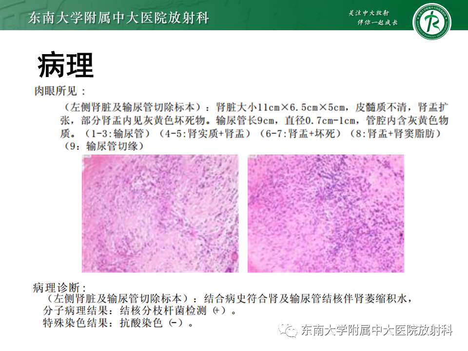 影像PPT - 【PPT】肾结核的影像诊断-5