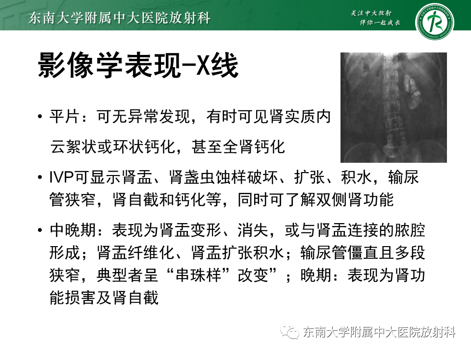 影像PPT - 【PPT】肾结核的影像诊断-13