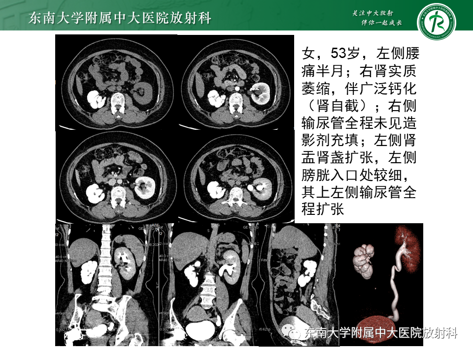 影像PPT - 【PPT】肾结核的影像诊断-17