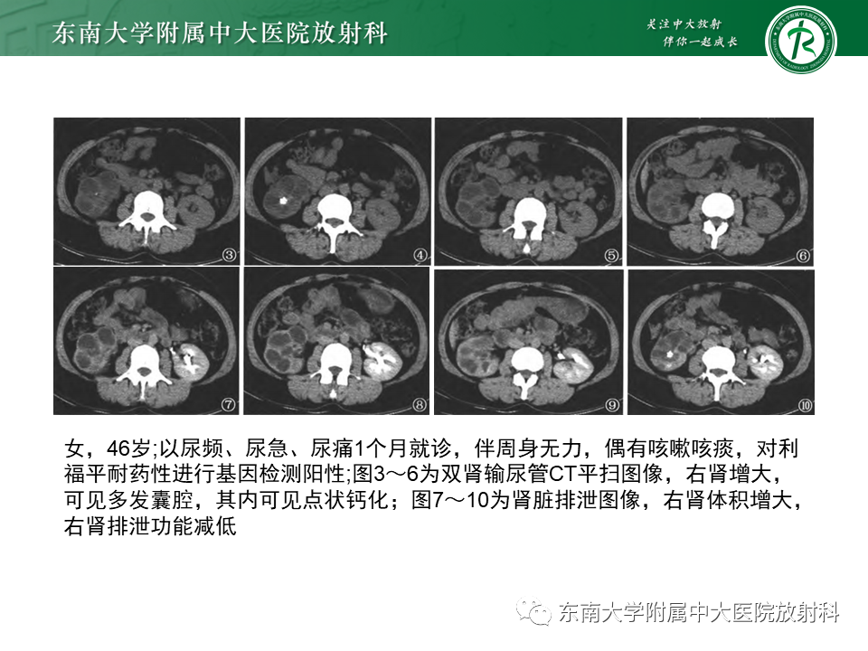 影像PPT - 【PPT】肾结核的影像诊断-16