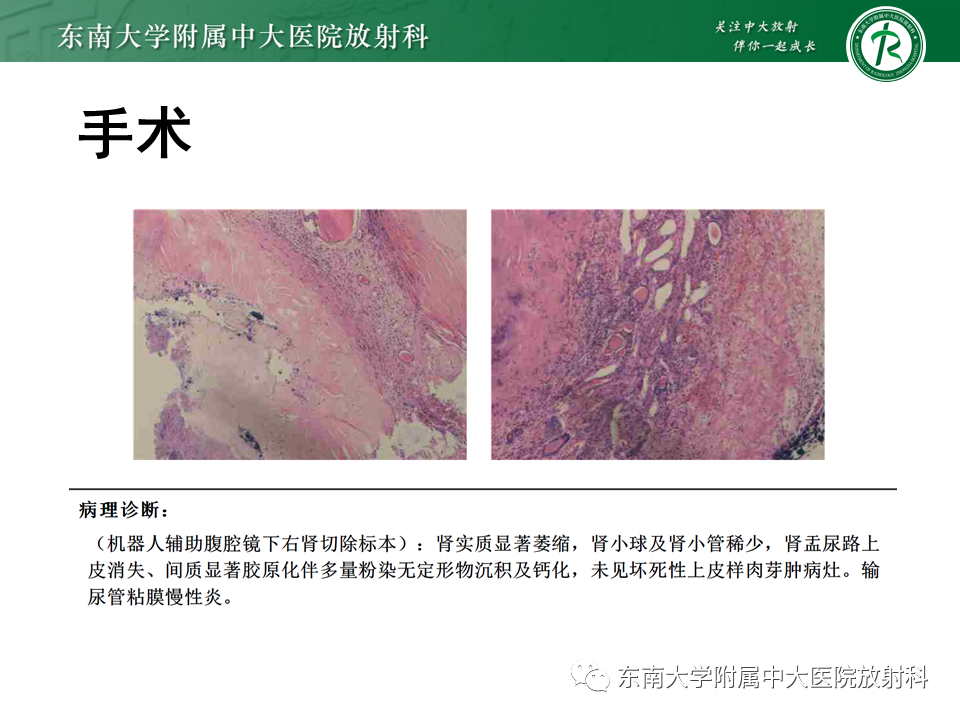 影像PPT - 【PPT】肾结核的影像诊断-18