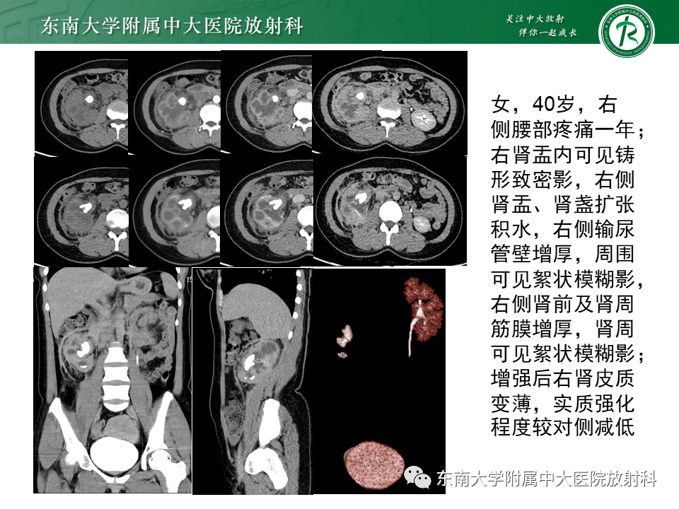 影像PPT - 【PPT】肾结核的影像诊断-21