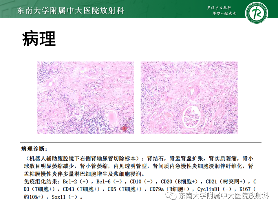 影像PPT - 【PPT】肾结核的影像诊断-22