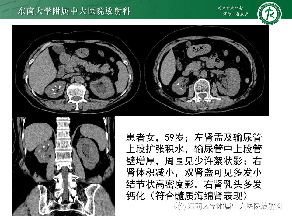 影像PPT - 【PPT】肾结核的影像诊断-24