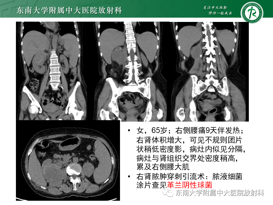 影像PPT - 【PPT】肾结核的影像诊断-26