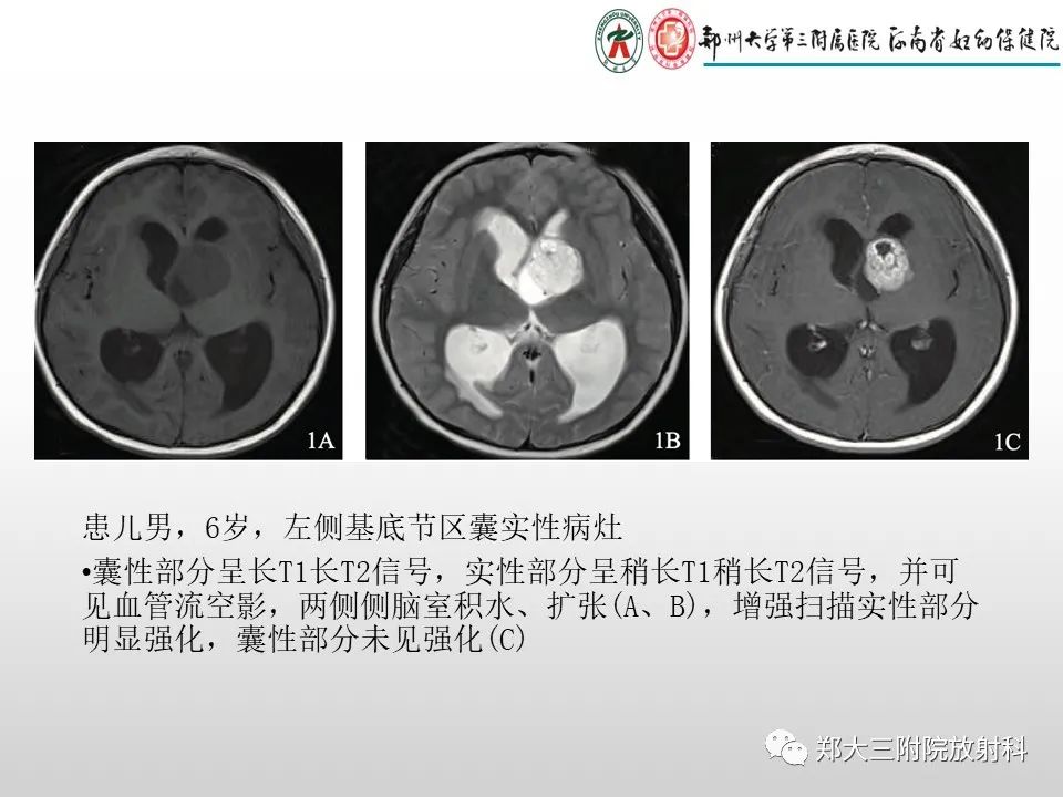 影像PPT - 【PPT】毛细胞星形细胞瘤的影像诊断-12