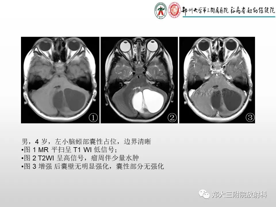 影像PPT - 【PPT】毛细胞星形细胞瘤的影像诊断-9