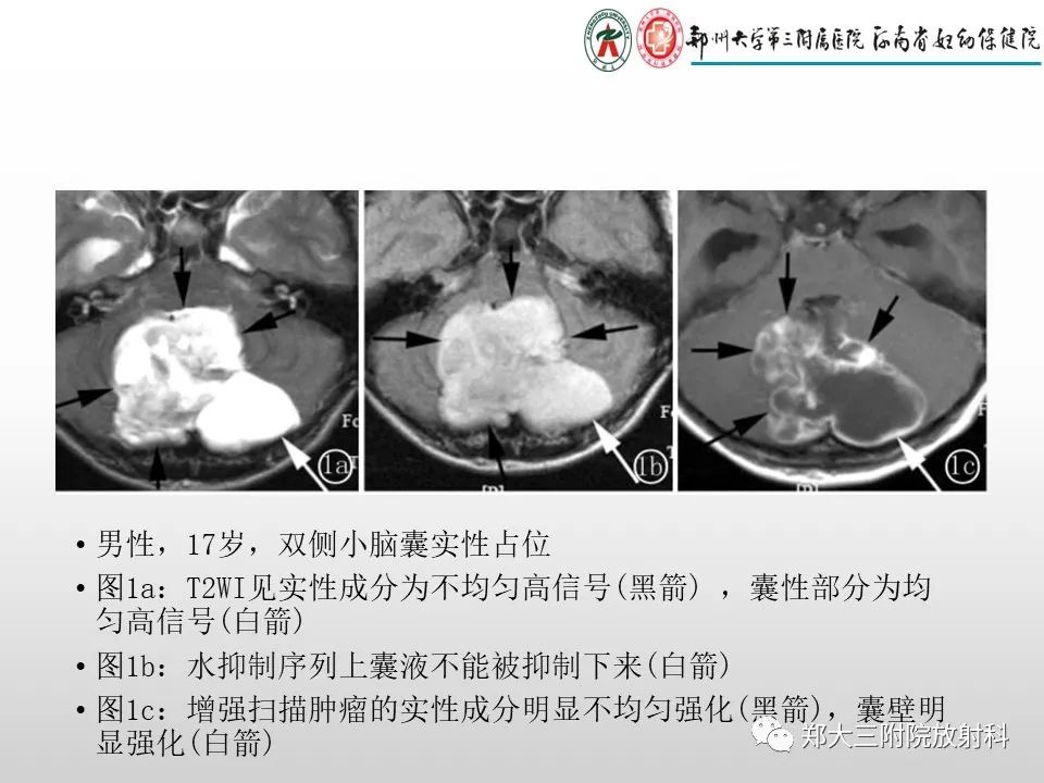 影像PPT - 【PPT】毛细胞星形细胞瘤的影像诊断-8