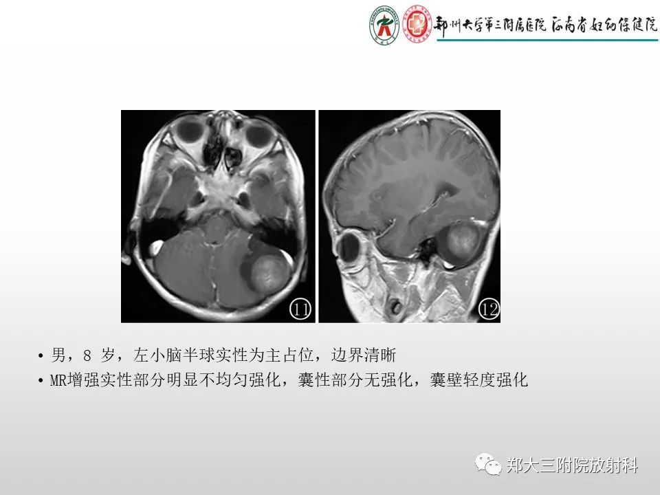 影像PPT - 【PPT】毛细胞星形细胞瘤的影像诊断-11