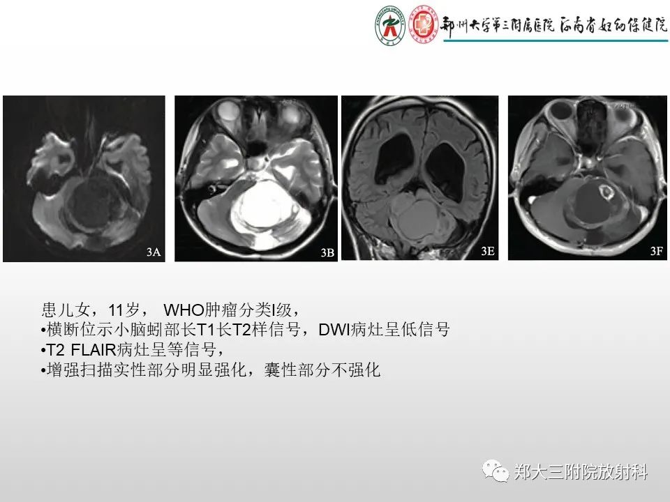影像PPT - 【PPT】毛细胞星形细胞瘤的影像诊断-10