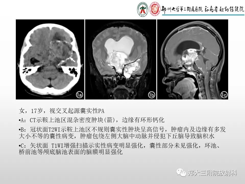 影像PPT - 【PPT】毛细胞星形细胞瘤的影像诊断-14