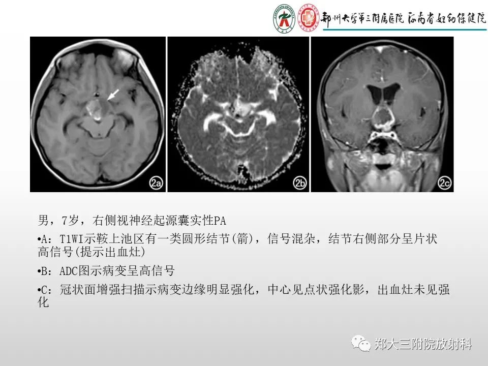 影像PPT - 【PPT】毛细胞星形细胞瘤的影像诊断-15