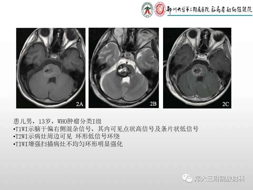 影像PPT - 【PPT】毛细胞星形细胞瘤的影像诊断-13