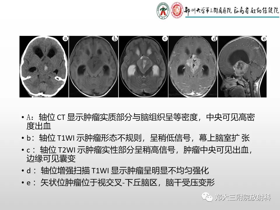 影像PPT - 【PPT】毛细胞星形细胞瘤的影像诊断-19