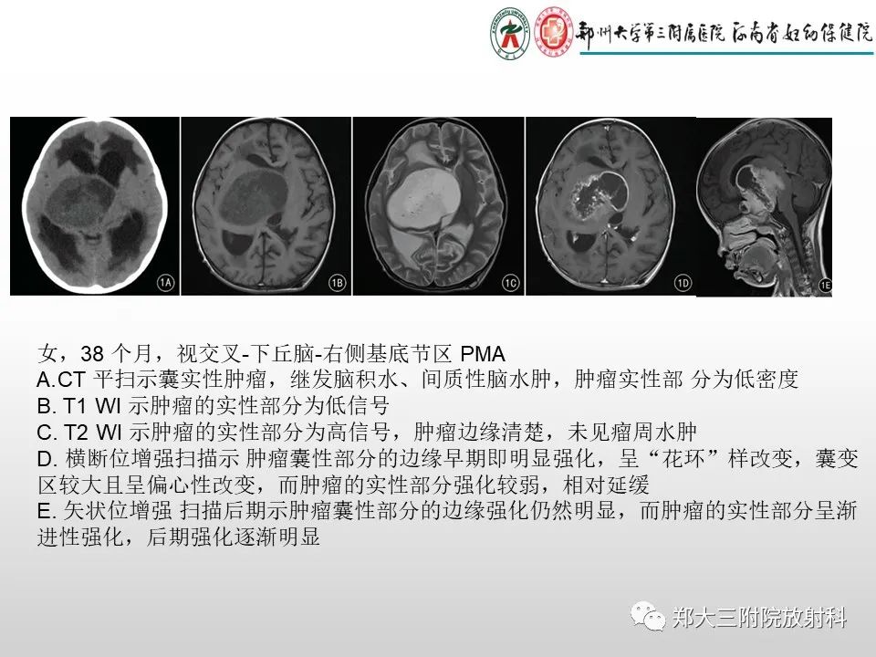 影像PPT - 【PPT】毛细胞星形细胞瘤的影像诊断-20