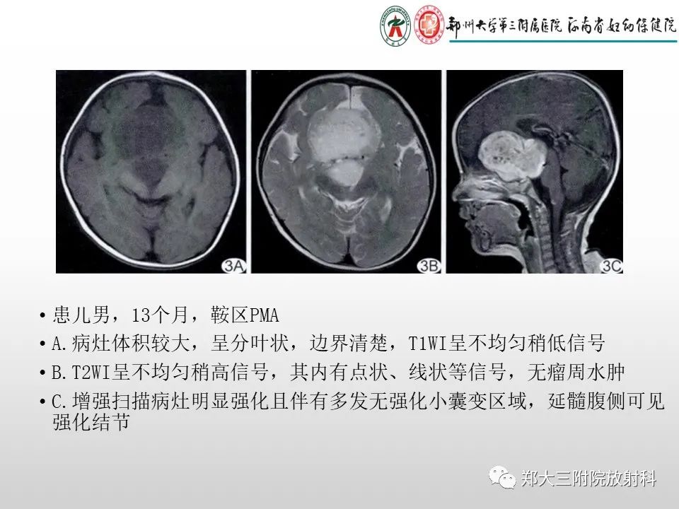 影像PPT - 【PPT】毛细胞星形细胞瘤的影像诊断-21