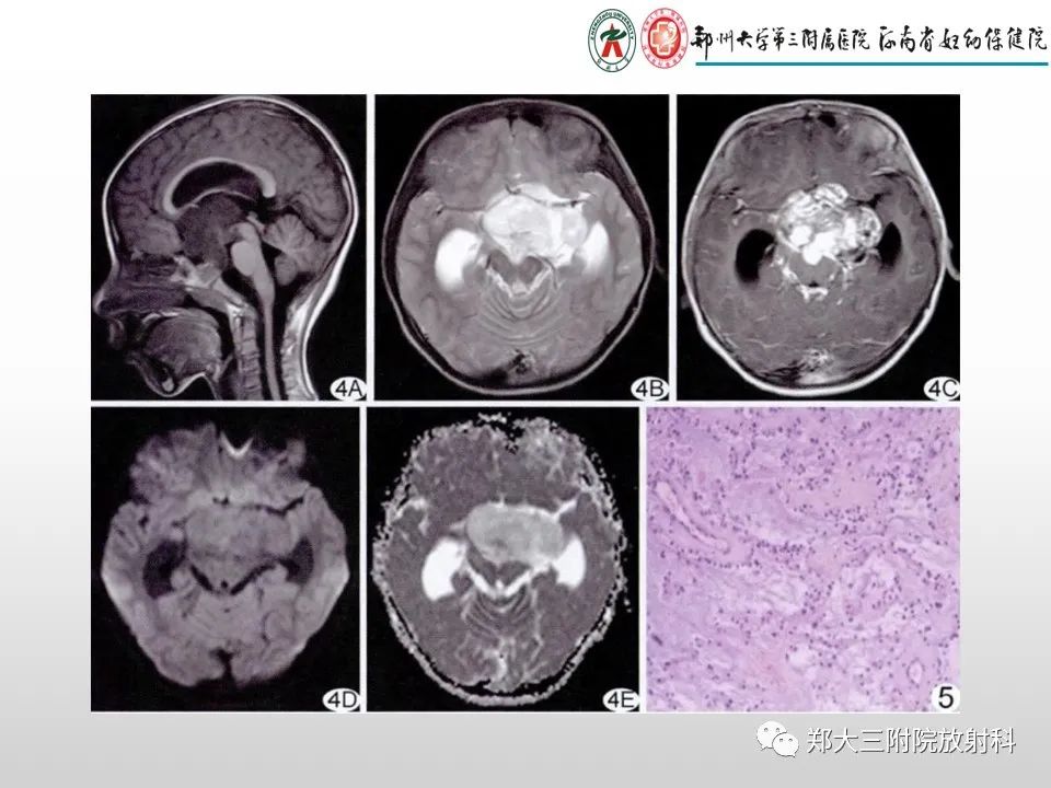 影像PPT - 【PPT】毛细胞星形细胞瘤的影像诊断-22