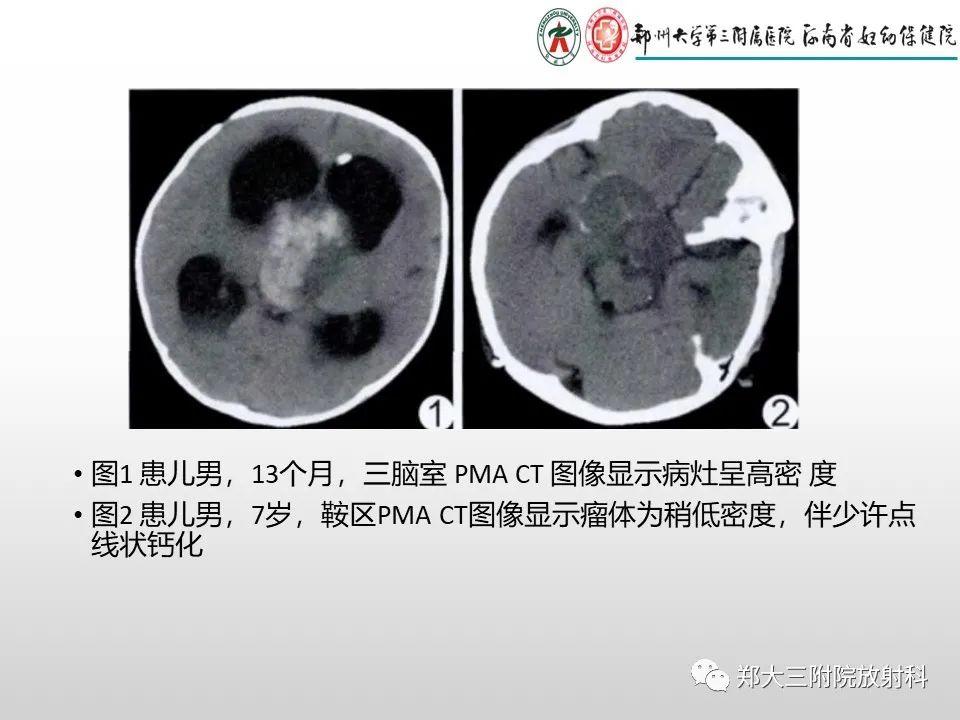 影像PPT - 【PPT】毛细胞星形细胞瘤的影像诊断-23