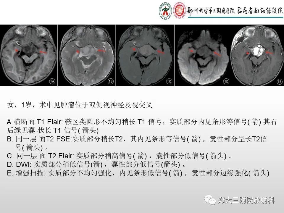 影像PPT - 【PPT】毛细胞星形细胞瘤的影像诊断-24