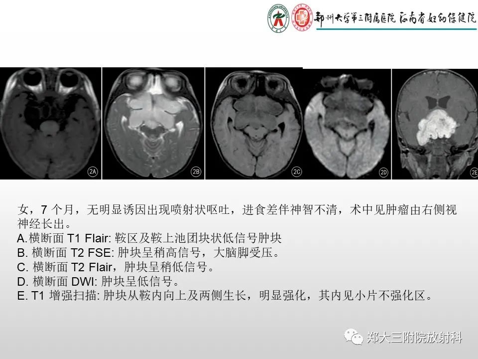 影像PPT - 【PPT】毛细胞星形细胞瘤的影像诊断-25